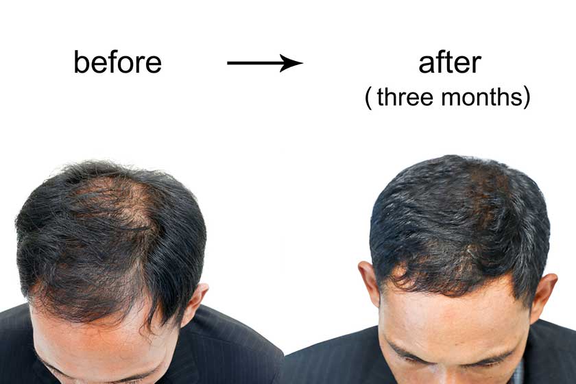 Hair Loss Treatment