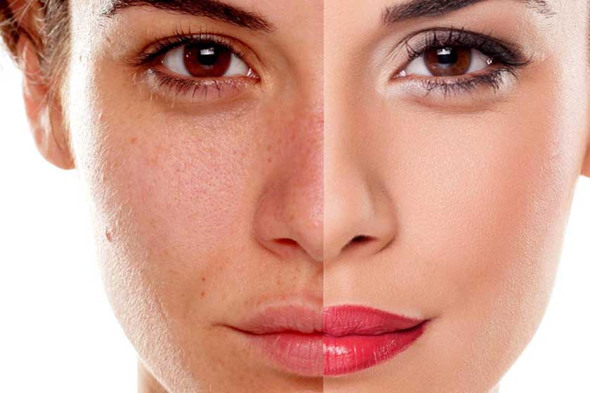 Pigmentation Treatment
