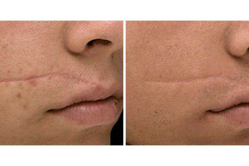 Scar Reduction