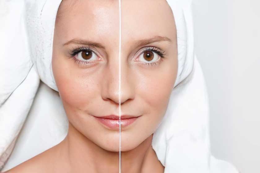 Wrinkle Reduction