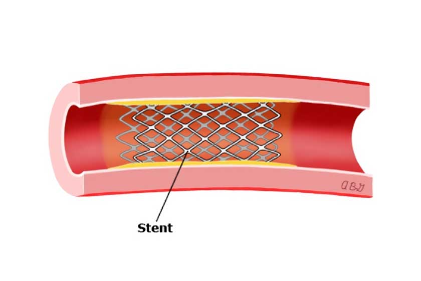 Angioplasty