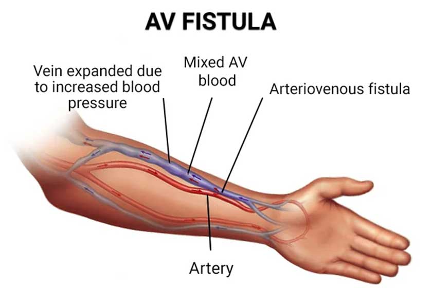 Arteriovenous fistula (AVF)