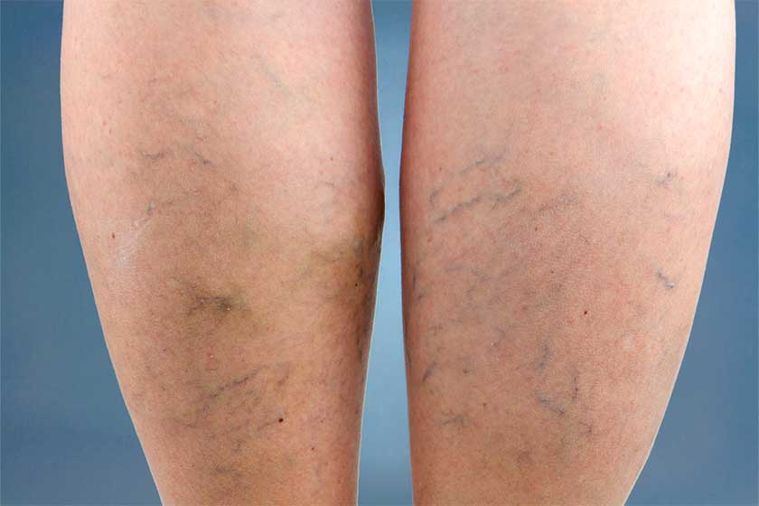 Peripheral Vascular and Venous Disease