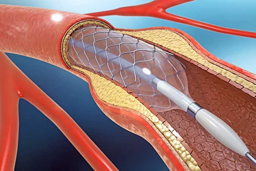 Stenting
